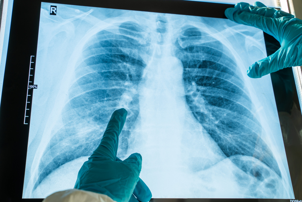 Thoracic Surgery